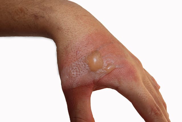 Atención para quemaduras de segundo grado