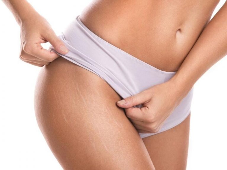 Estrías: por qué aparecen y cómo prevenirlas Estrías: por qué aparecen y cómo prevenirlas