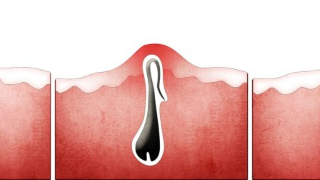 Cómo quitar un pelo encarnado 154 Tome en cuenta