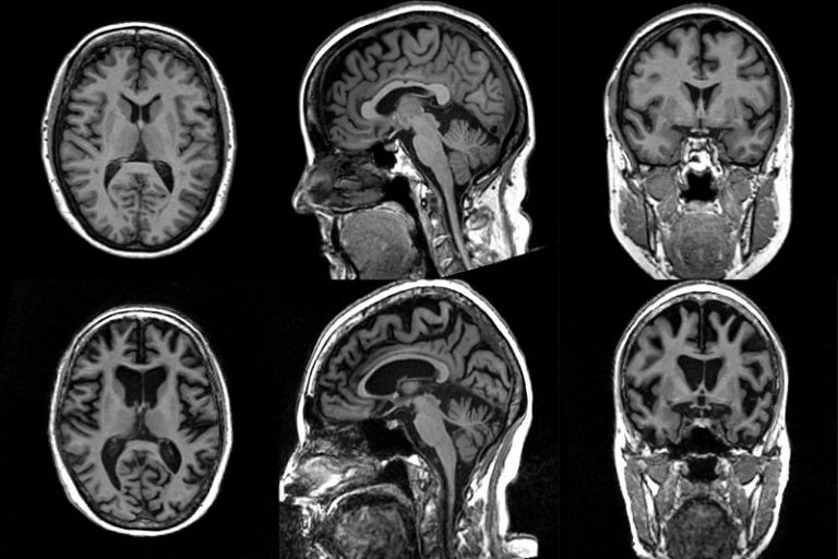 Los anestésicos pueden favorecer la propagación de la proteína clave del Alzheimer en el cerebro