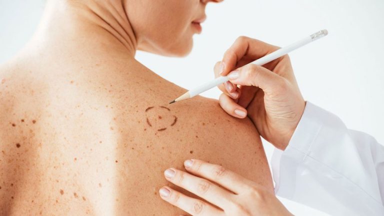 Lunares: esto es lo que debes vigilar para prevenir un cáncer