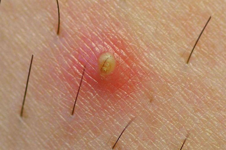 Cómo quitar un pelo encarnado