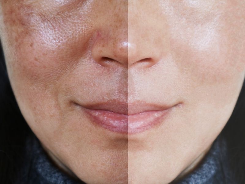 Qué es el ácido glicólico