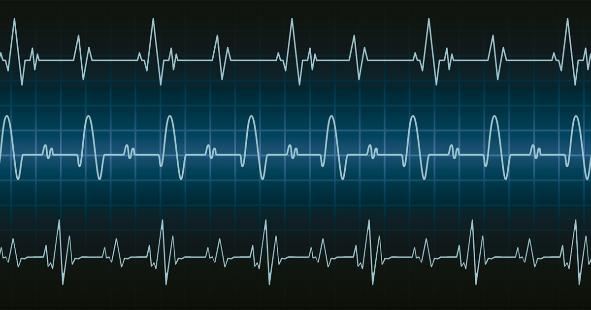 Qué es el síndrome de Brugada