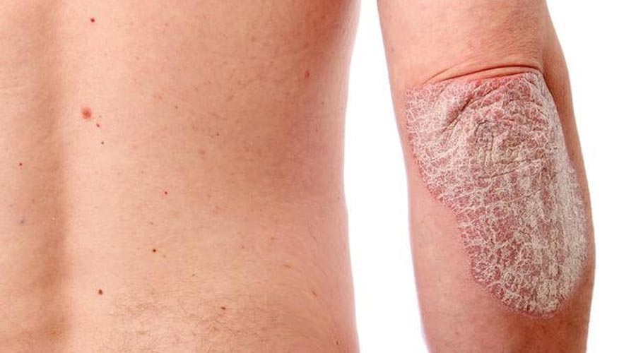 Qué es la artritis psoriásica