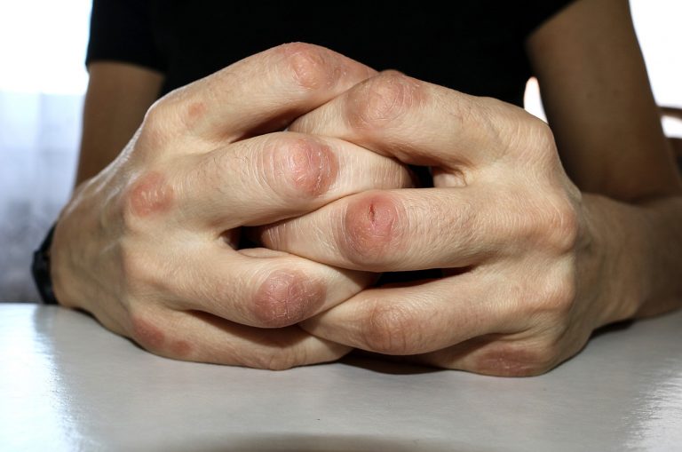 Qué es la artritis psoriásica