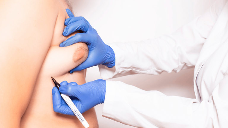 Qué es la ginecomastia