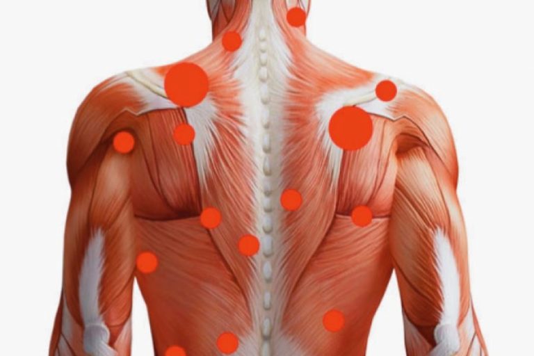 Qué son los puntos gatillo