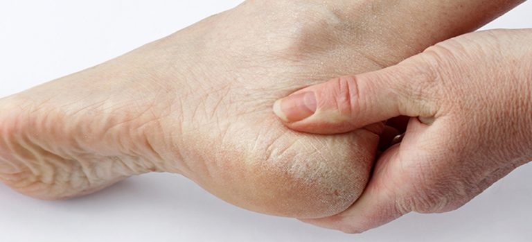 Cómo acabar con los talones agrietados