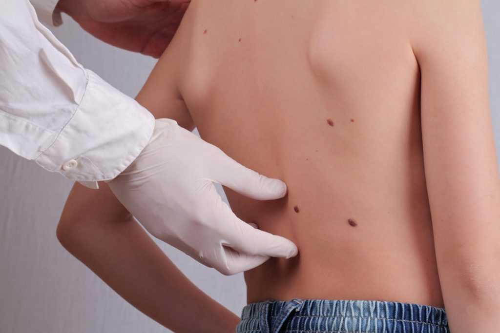 Vigila el diámetro de los lunares cáncer