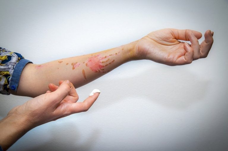 Cómo tratar las quemaduras