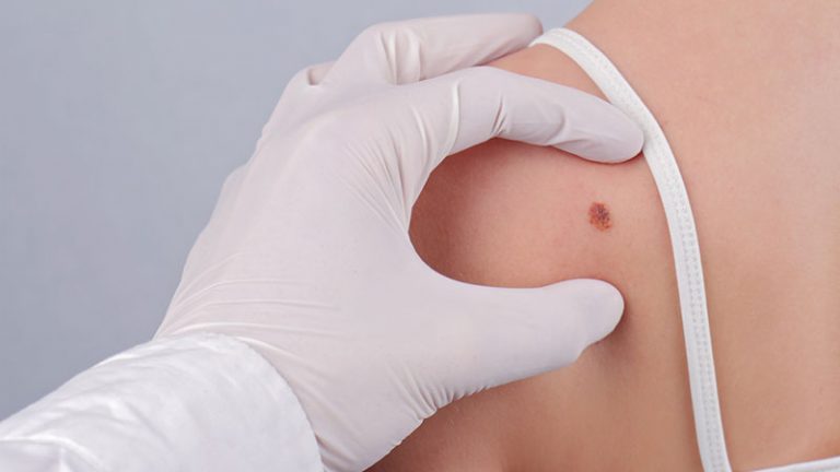 Investigadores españoles avanzan en nuevas terapias contra el cáncer de piel