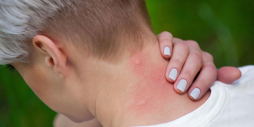 Cómo tratar las picaduras de mosquitos 1 ¿Cómo atender una picadura de mosquito?