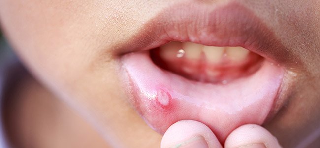 Cómo curar las llagas de la boca 1 ¿ Por qué aparecen llagas en la boca?