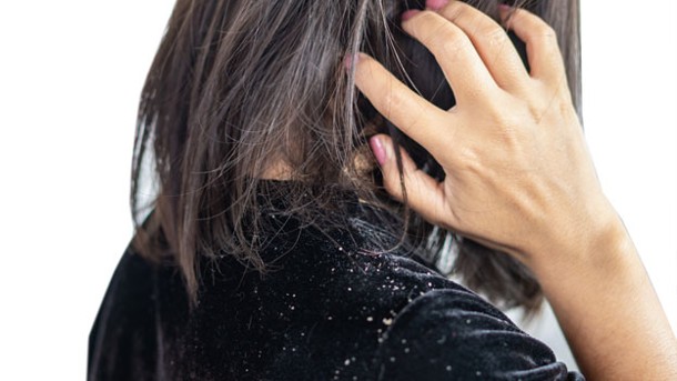 ¿Qué remedios naturales puedo usar para acabar con la caspa?