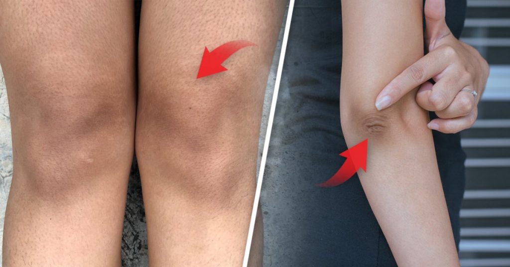 ¿Por qué se mancha la piel de los codos y rodillas?