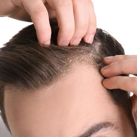 Aceites especiales que pueden combatir la caspa