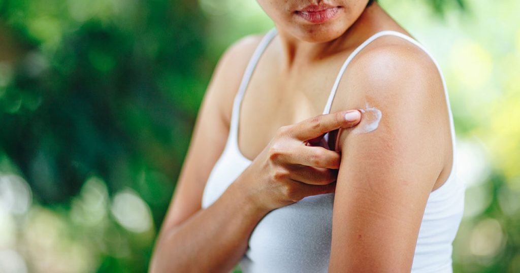 Cómo tratar las picaduras de mosquitos 3 Remedios caseros para evitar los mosquitos