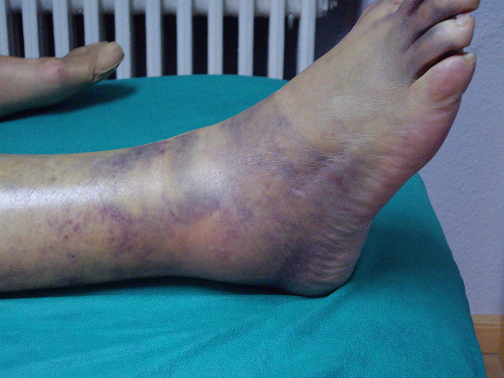 El cuidado correcto es fundamental para una recuperación completa