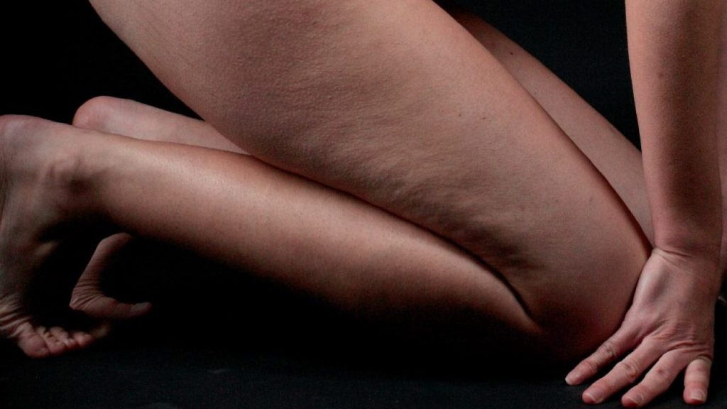 ¿Cómo disminuir la celulitis?