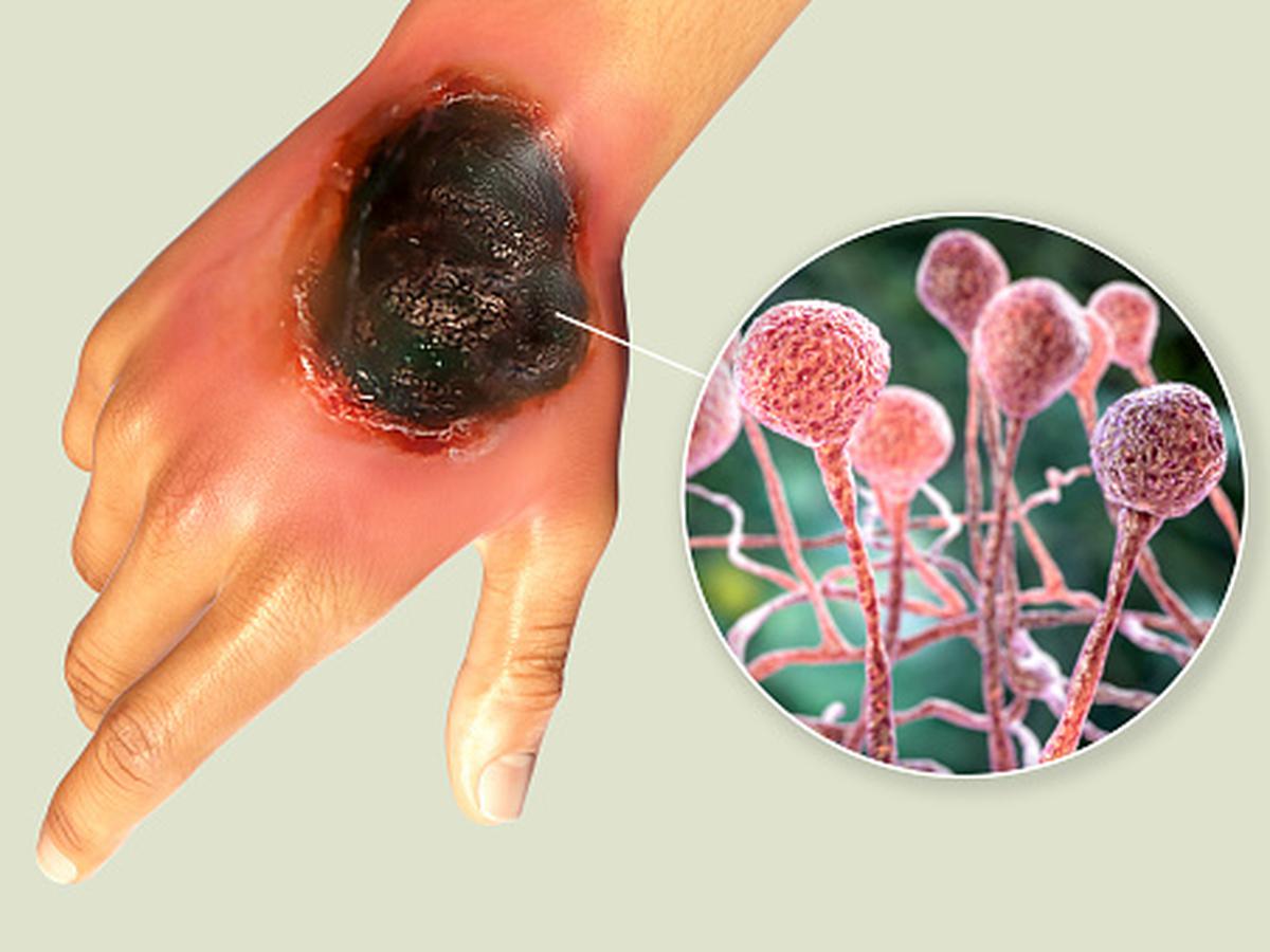 Qué es el hongo negro y cómo se contagia 1 Qué es el hongo negro y cómo se contagia
