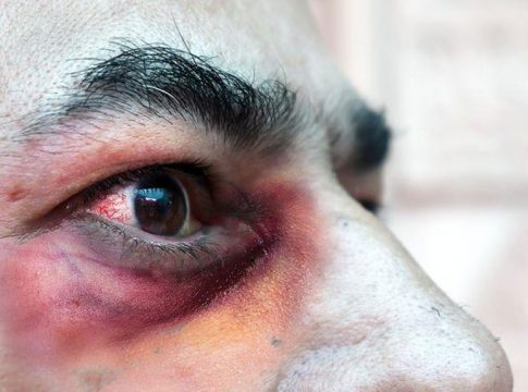 Qué es el hongo negro y cómo se contagia Qué es el hongo negro y cómo se contagia