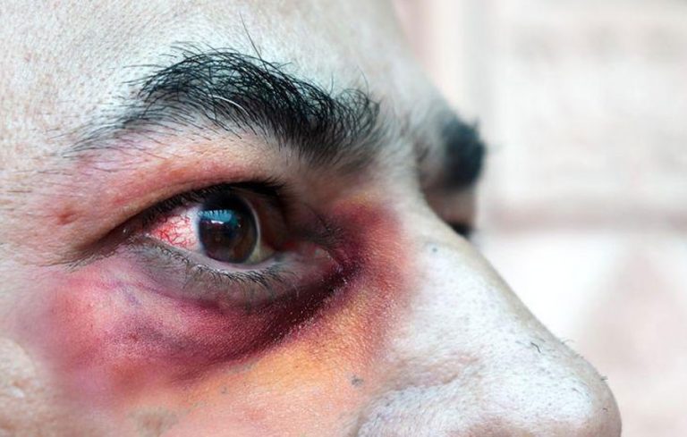 Qué es el hongo negro y cómo se contagia