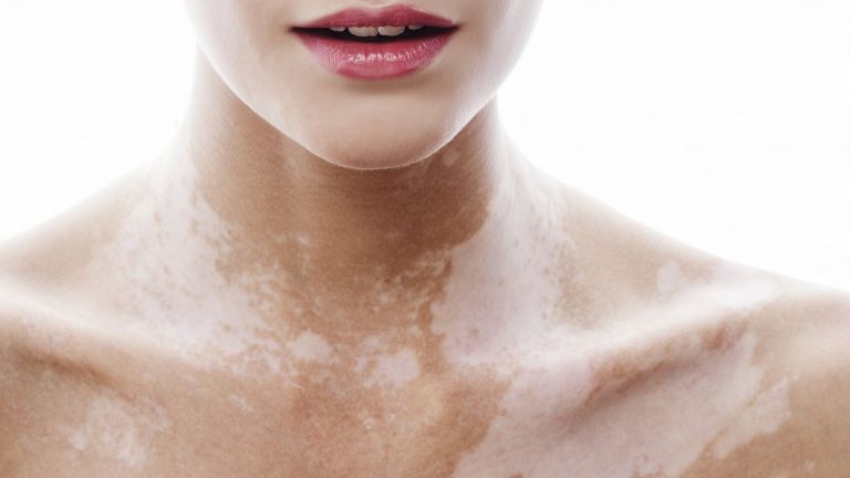 Qué es el vitíligo