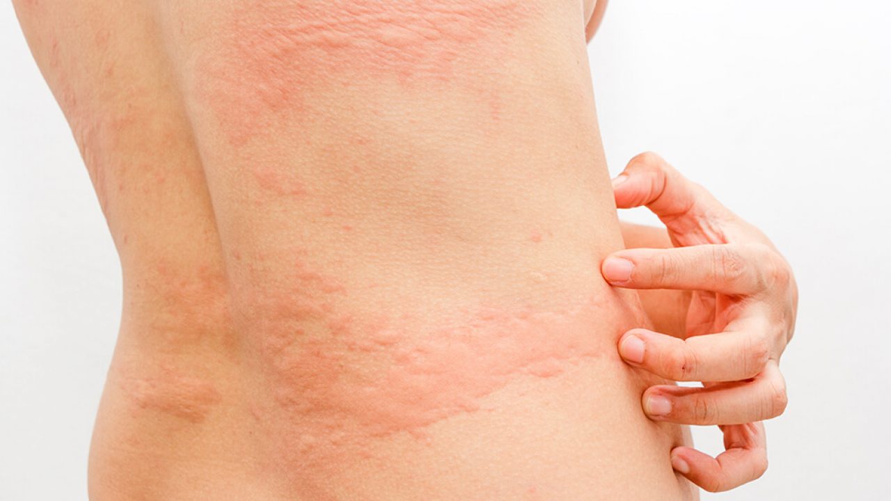 Qué es la alergia al agua