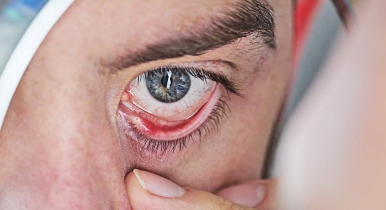 Qué es la mucormicosis