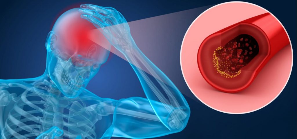 Qué es un ictus isquémico 1 Que es un ictus isquemico 1