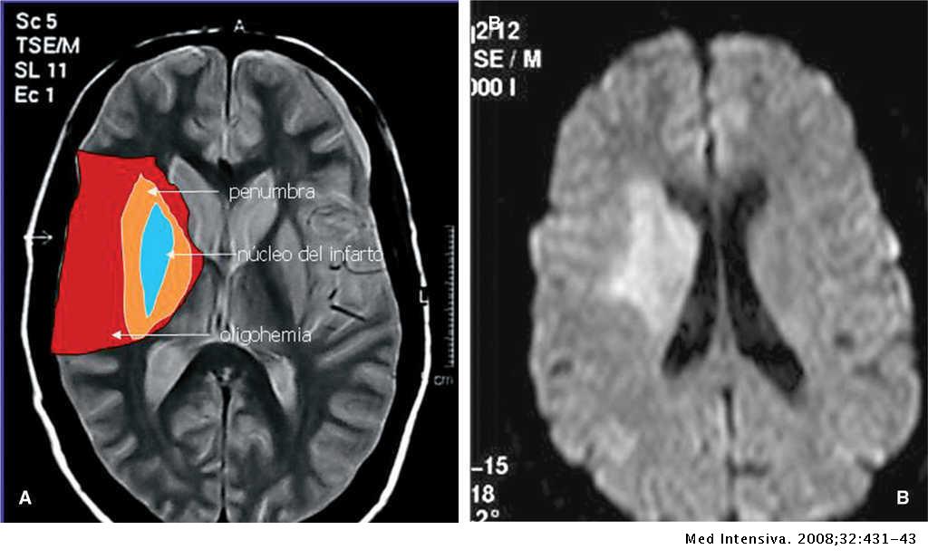 Qué es un ictus isquémico 2 Que es un ictus isquemico 2