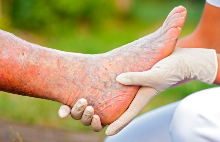 Qué es una trombosis