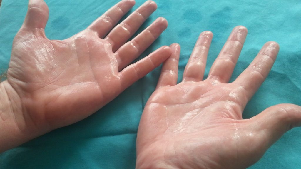 ¿Qué es la Hiperhidrosis?