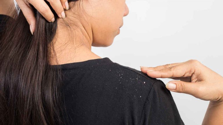 Cómo fulminar la caspa con remedios caseros