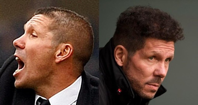 Injertos capilares FUE Simeone Jordi Alba