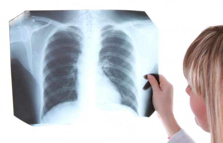 La Covid-19 ha contribuido a reducir el retraso de los diagnósticos de tuberculosis