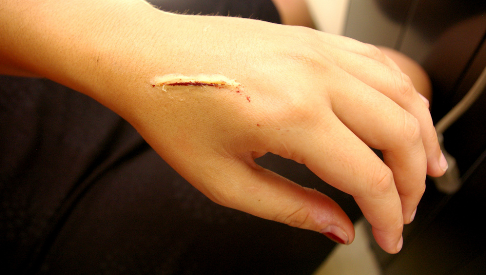 ¿Se puede o no ocultar una cicatriz?