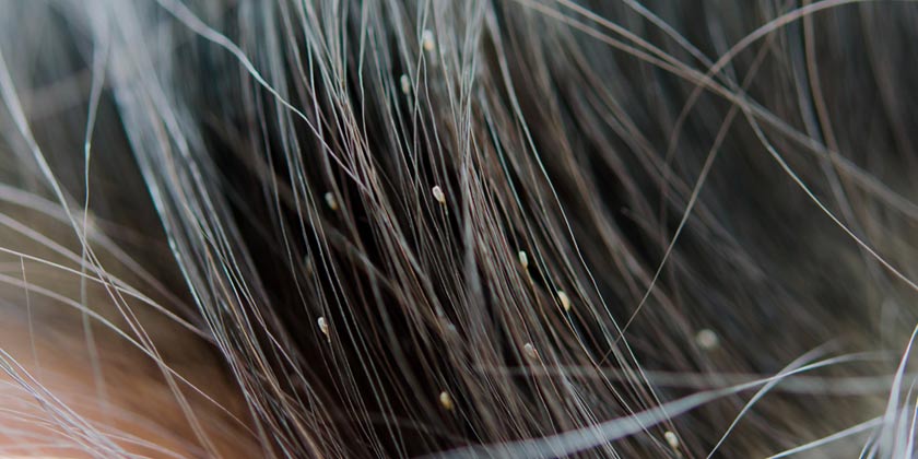 ¿Cómo saber si tengo o no piojos?