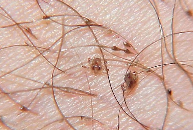 Cómo saber si tienes ladillas púbicas 1 ¿Cómo identificar que tienes ladillas púbicas?