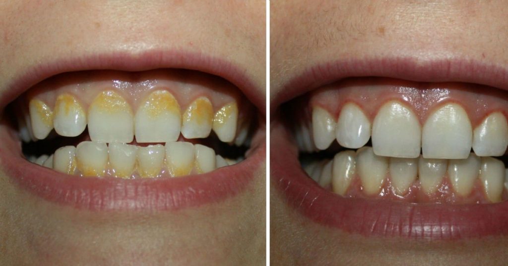 Cómo quitar el sarro de los dientes 1 ¿Hay remedios naturales para quitar el sarro de los dientes?