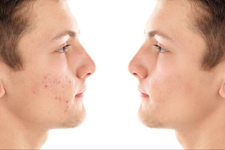 El tratamiento antiacné que acaba con el rastro de cualquier grano: Sapphira Privé Logroño