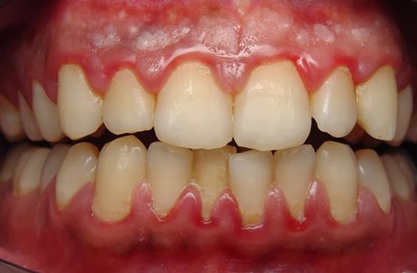 Cómo tratar las encías inflamadas 2 La periodontitis también ocasiona encías inflamadas