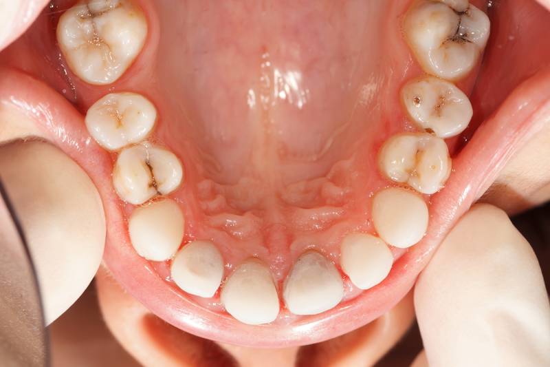 ¿Qué pasa cuando las caries se complican?