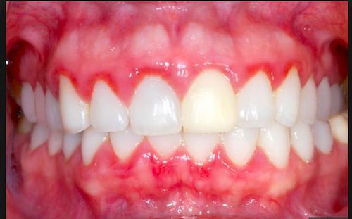 Cómo tratar las encías inflamadas 3 Otras razones que ocasionan molestias