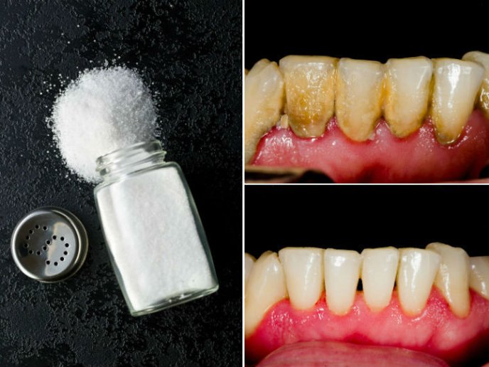 Cómo quitar el sarro de los dientes 3 Una mezcla de limón para limpiar los dientes