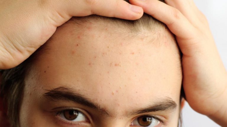 Alimentos que causan acné y no dejas de consumir