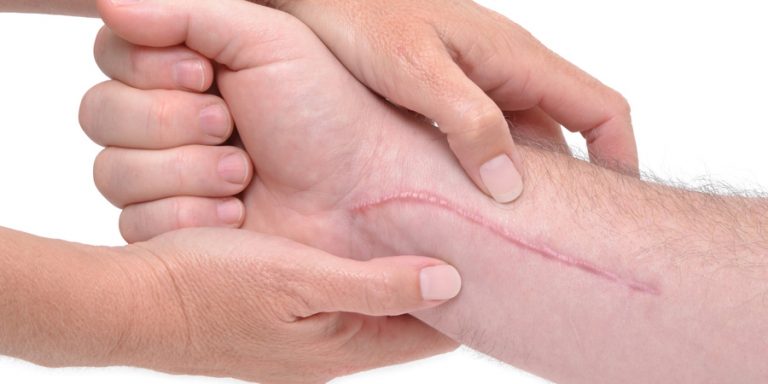 Cómo ocultar una cicatriz