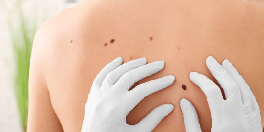 Cáncer de piel: señales que te avisan de que puedes tenerlo