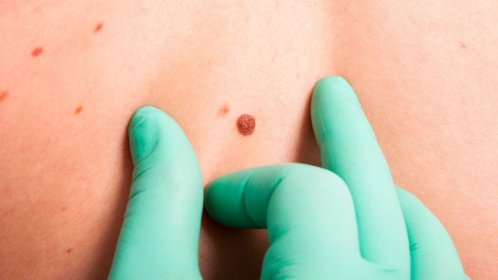 ¿Cuáles son los tipos de cáncer de piel?